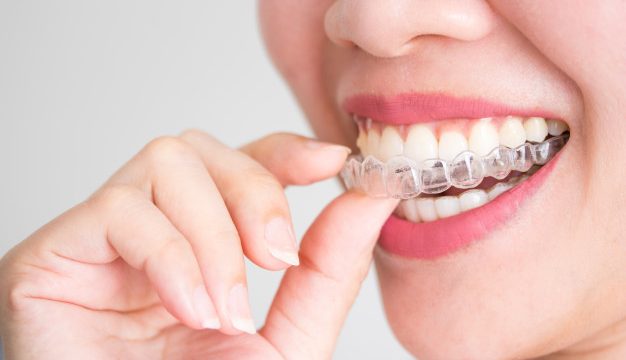 Types Of Dental Braces Mumbai | Invisible Braces Treatment India